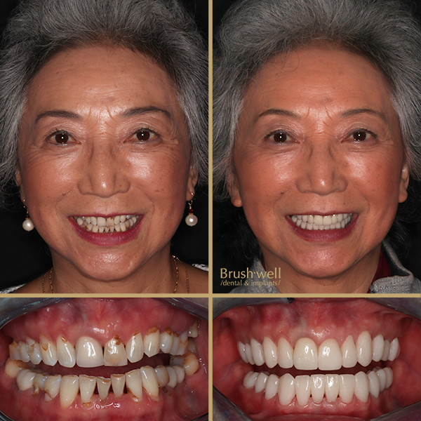 Hyperrealistic Smile Makeover Dental Implant Transformation Image of Older Woman