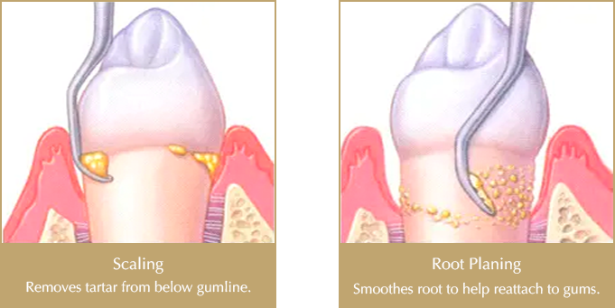 Disadvantages and Advantages of Deep Cleaning Teeth