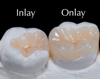 Inlays and Onlays - Brushwell Dental & Implants