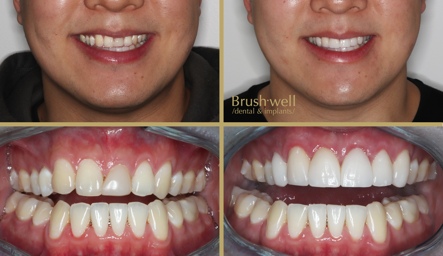Hyperrealistic Smile Makeover Cosmetic Veneer Transformation Image of Young Adult Male