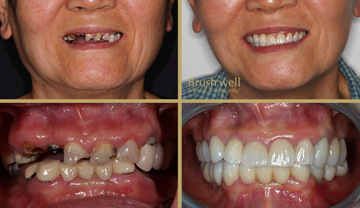 Hyperrealistic Dental Implants Dental Implant Transformation Image of Older Woman