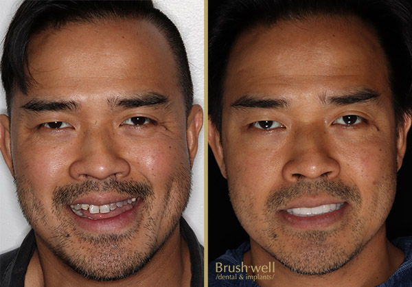 Cosmetic Veneer Transformation Image of Young Adult Male