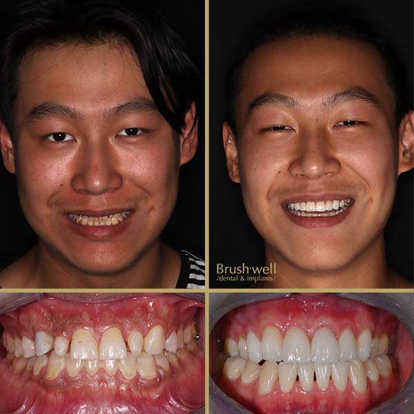 Hyperrealistic Smile Makeover Cosmetic Veneers Transformation Image of Young Adult Male