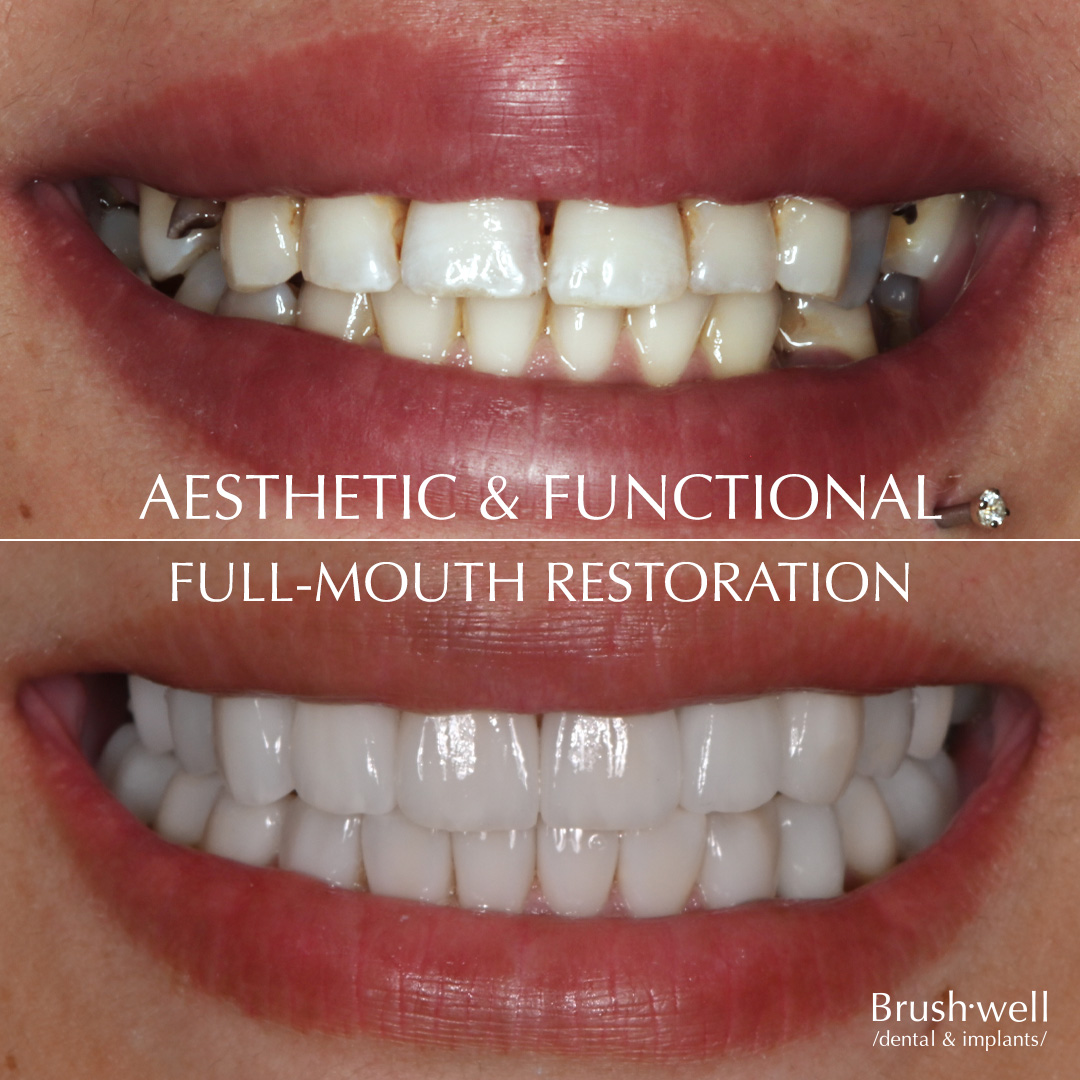 Aesthetic and functional full-mouth restoration