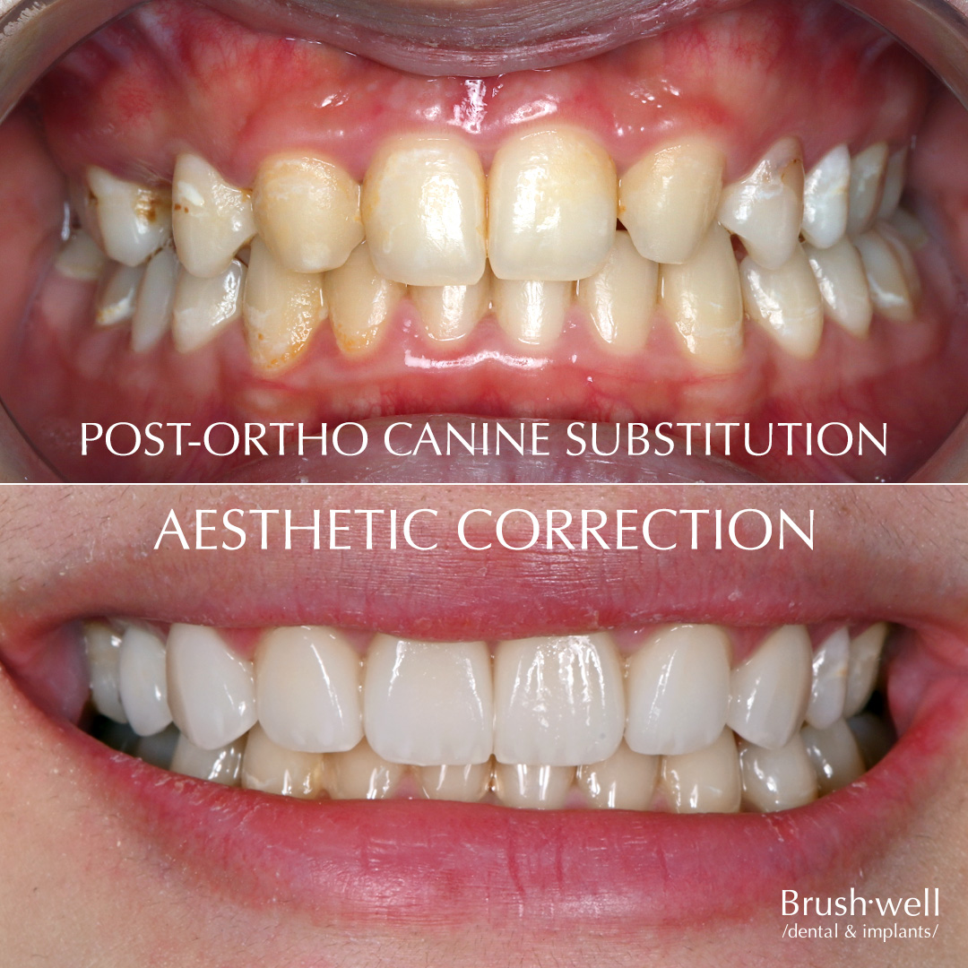 Post-ortho canine substitution for aesthetic correction