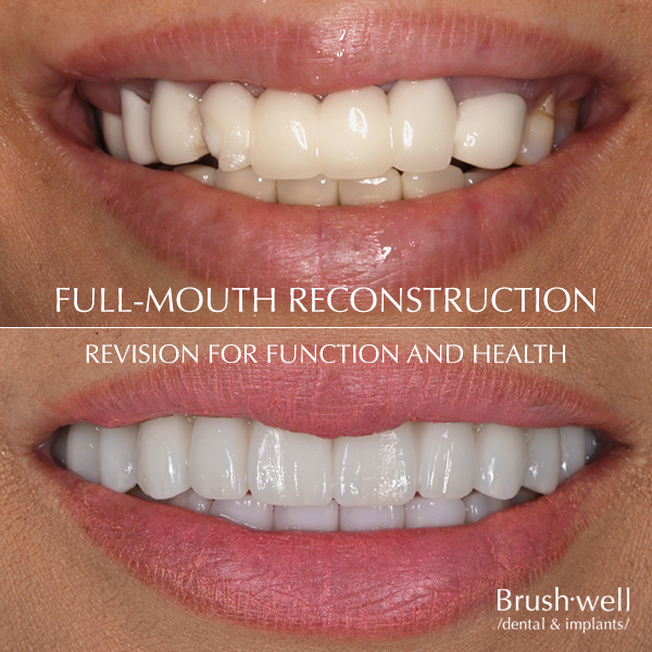 Full-mouth reconstruction for function and health