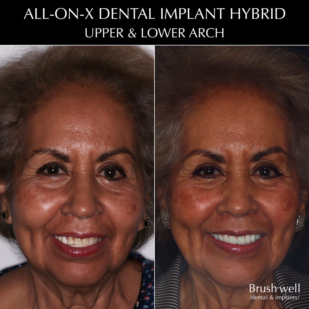 All-on-X dental implant hybrid for upper and lower arch