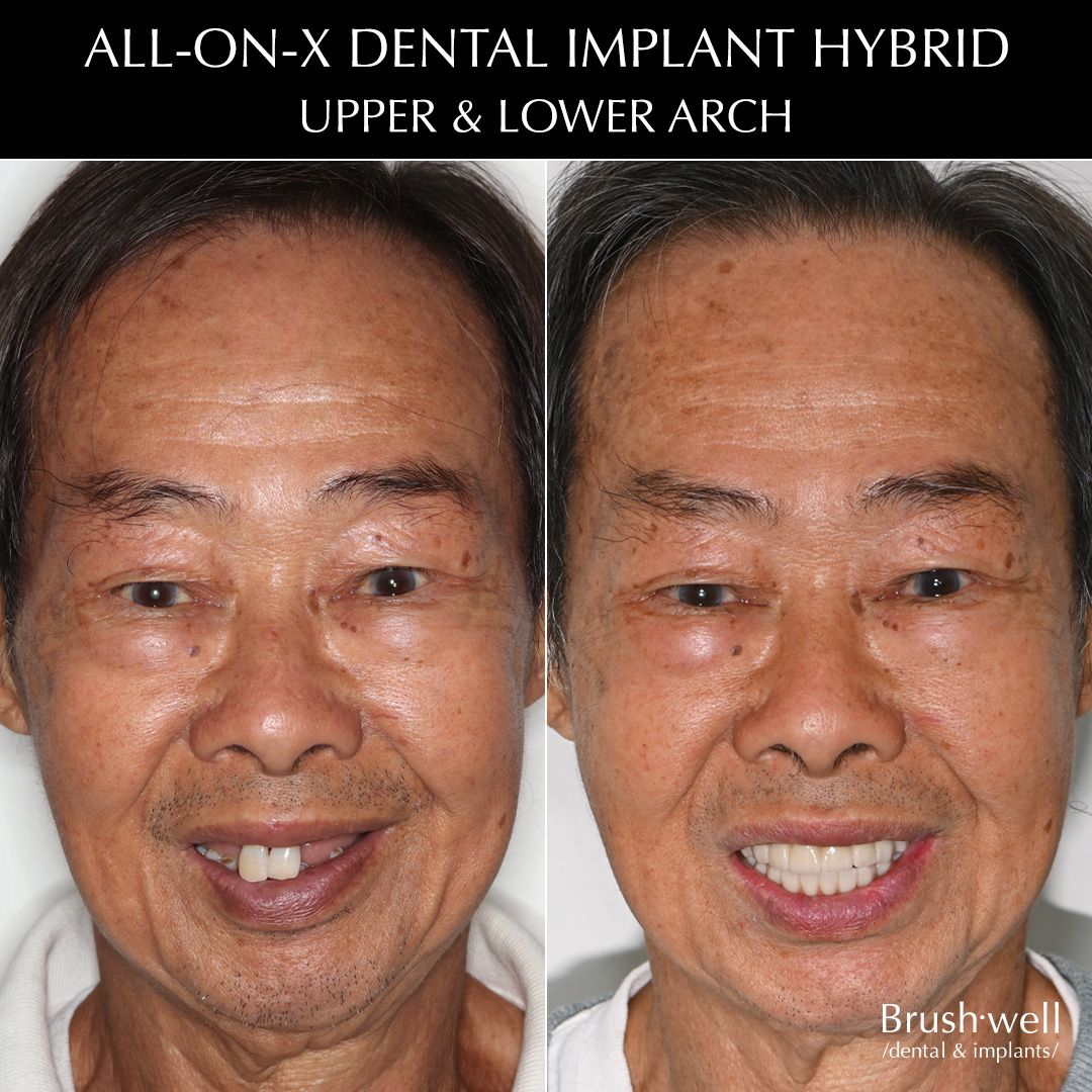 All-on-X dental implant hybrid for upper and lower arch