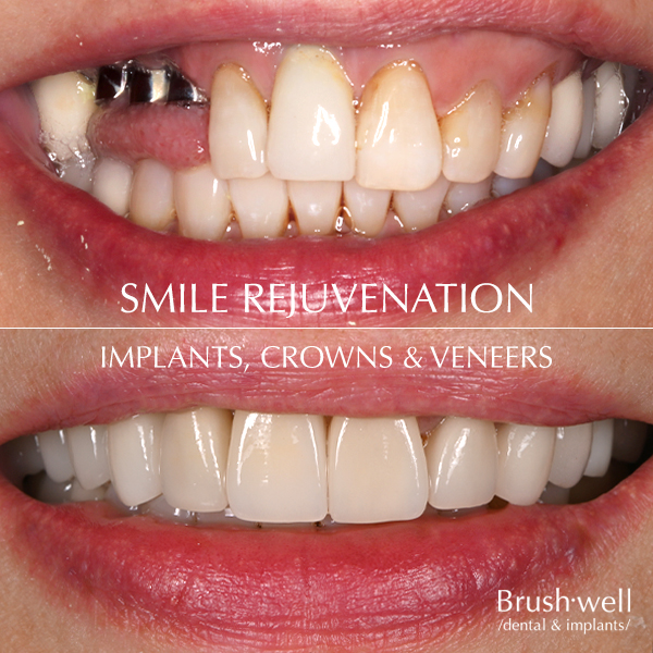 Smile rejuvenation with implants, crowns, and veneers