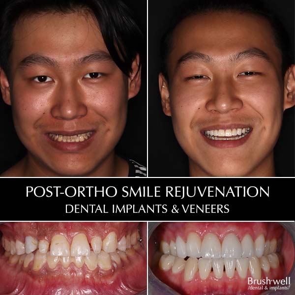 Post-ortho smile rejuvenation with dental implants and veneers