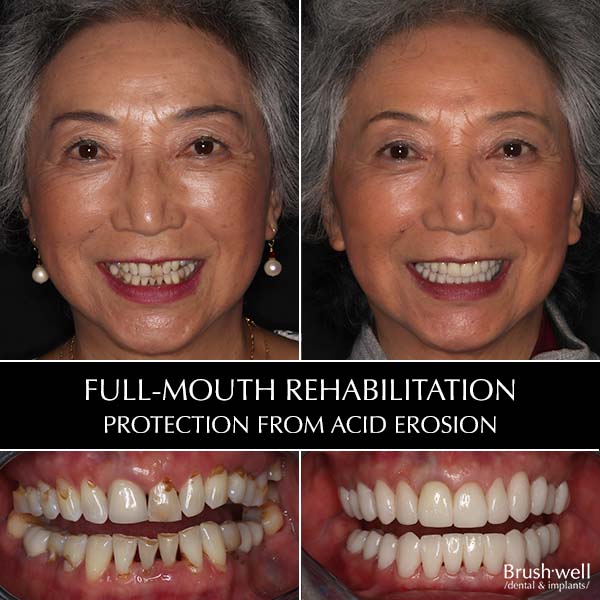 Full-mouth rehabilitation to protect from acid erosion