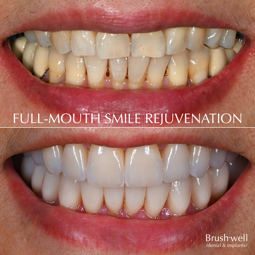 Full-mouth smile rejuvenation