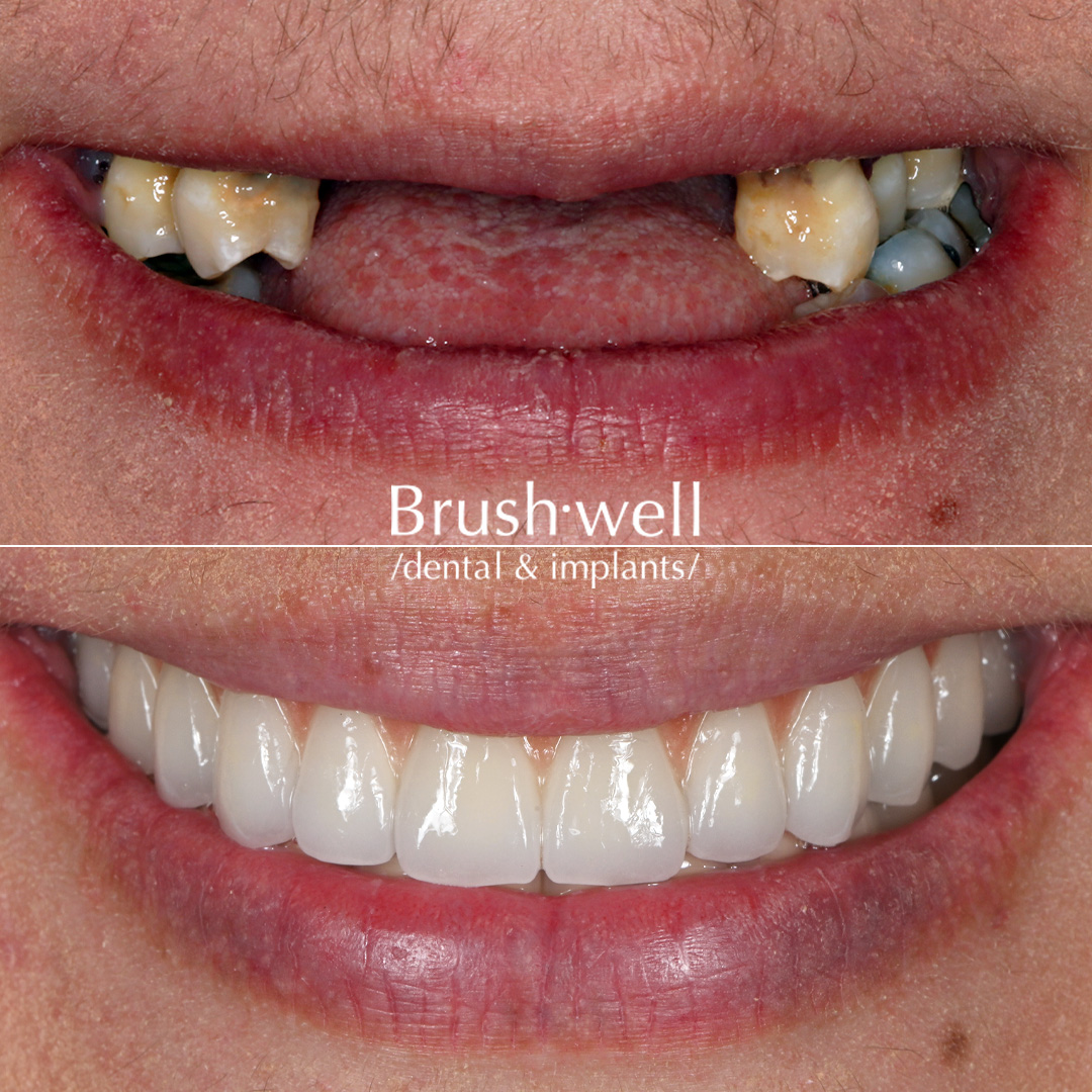 Aesthetic and functional full-mouth restoration