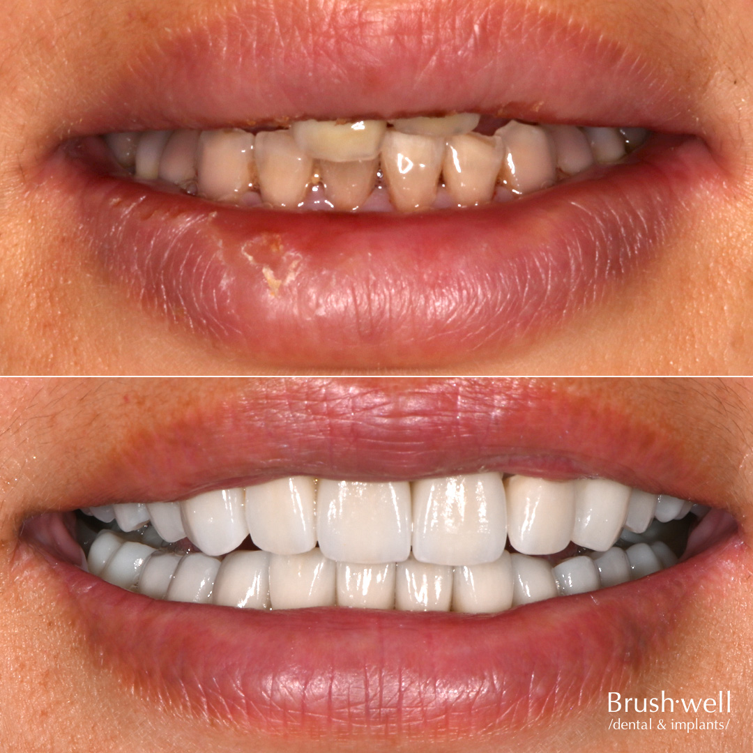 Smile transformation with dental veneers