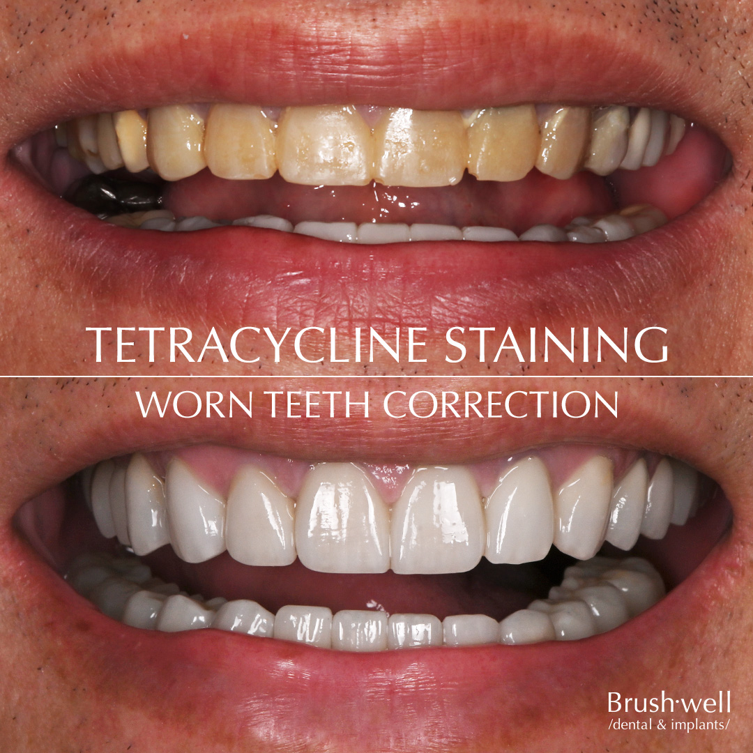 Correction for worn teeth and tetracycline staining